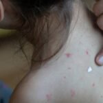 Sarampión en México se dispara en 2026, los casos aumentan 137% y superan cifras de 2025